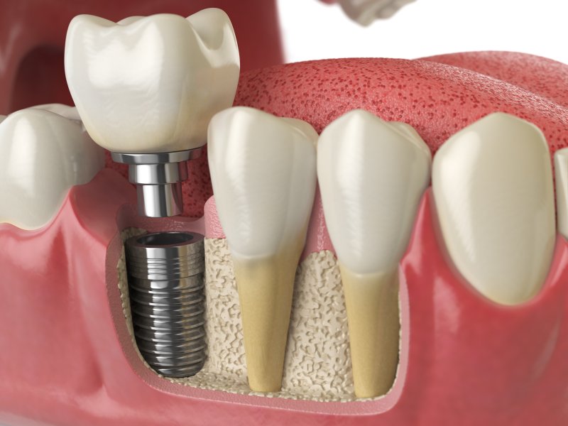 Get high-quality dental implants in Albania at Aurea Dental Clinic. Trusted care, expert surgeons, and affordable prices for lasting smiles.