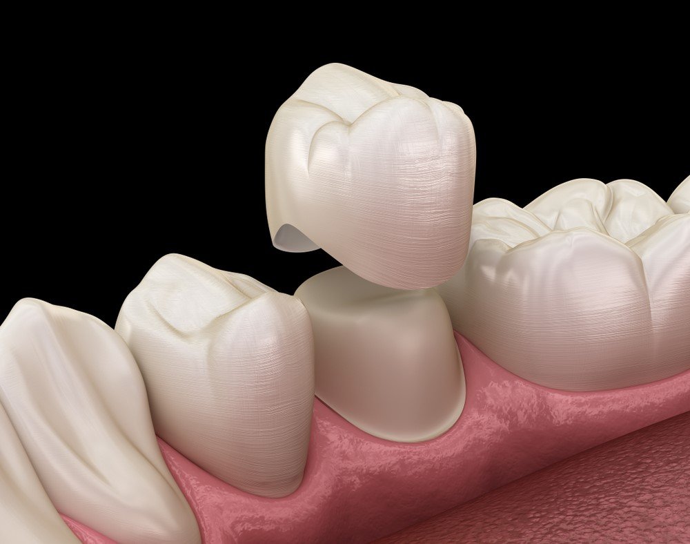 Get high-quality dental crowns in Albania for a natural, durable smile. Expert care and affordable prices at our trusted clinic.