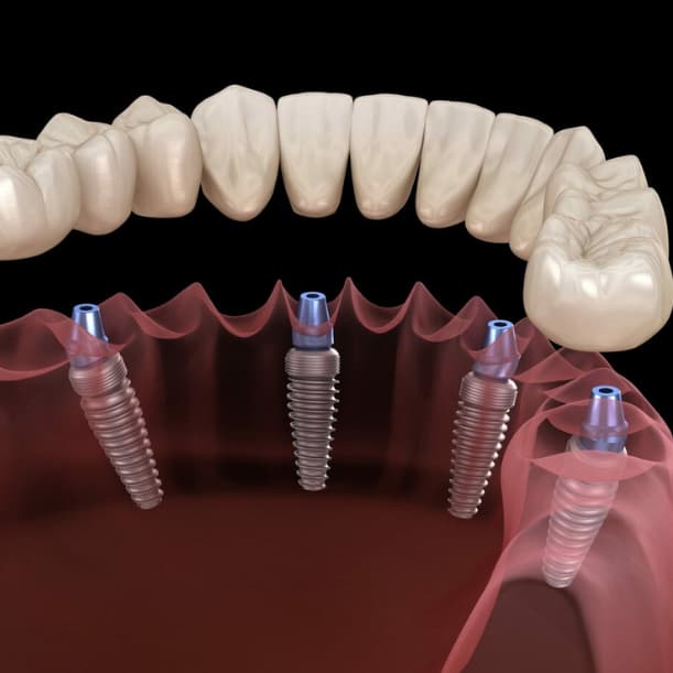 Restore your smile with All on 4 implants in Albania. Affordable full-arch dental solutions with expert care and modern technology.