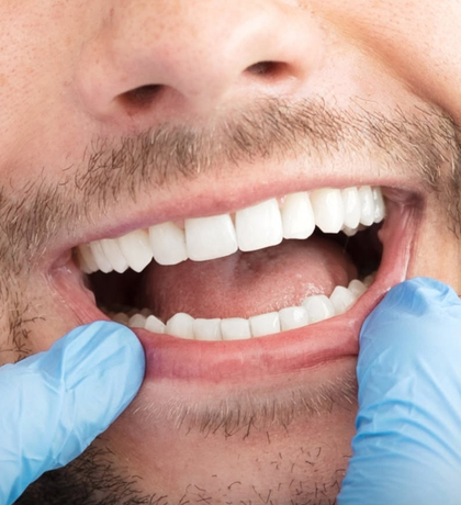 Hollywood Smile makeover at a Dental Clinic in Albania