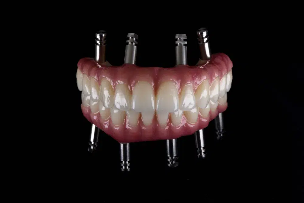 Restore your smile with All on 4 implants in Albania. Affordable full-arch dental solutions with expert care and modern technology.