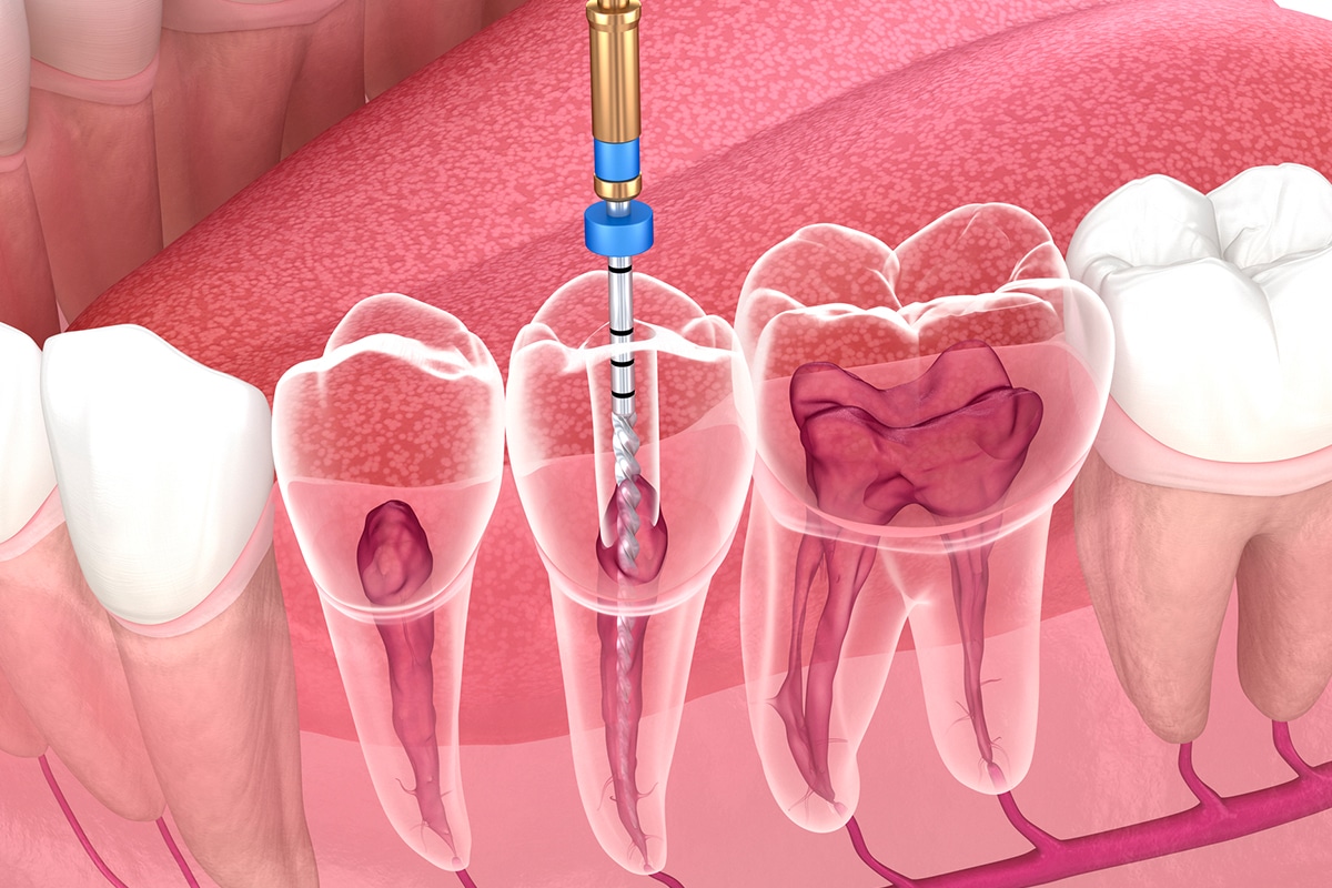 Looking for expert endodontics in Albania? Aurea Dental Clinic offers painless root canal treatments with advanced technology.
